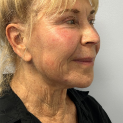 HourLift Before & After Patient #10880