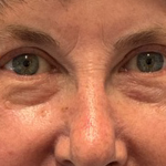 Blepharoplasty Before & After Patient #10865
