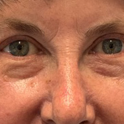 Blepharoplasty Before & After Patient #10865