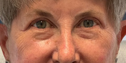 Blepharoplasty Before & After Patient #10865