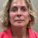 HourLift Before & After Patient #10874
