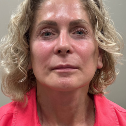 HourLift Before & After Patient #10874