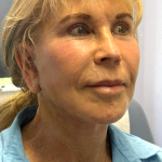HourLift Before & After Patient #10880