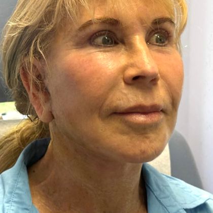 HourLift Before & After Patient #10880