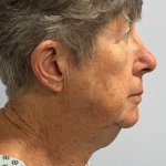 HourLift Before & After Patient #10860
