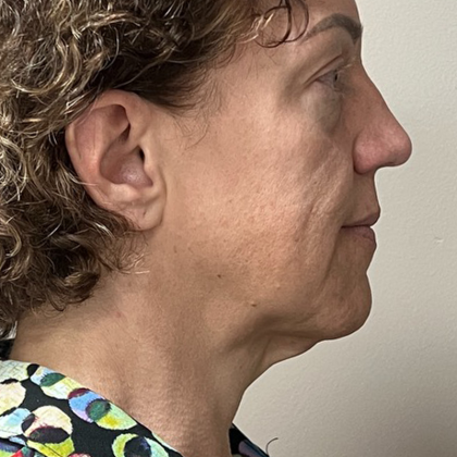 HourLift Before & After Patient #10879