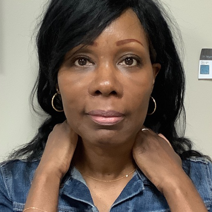 HourLift Before & After Patient #10885