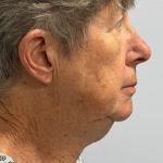 HourLift Before & After Patient #10891