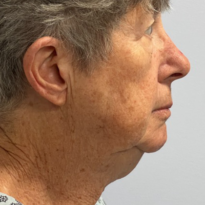HourLift Before & After Patient #10891