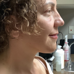 HourLift Before & After Patient #10879