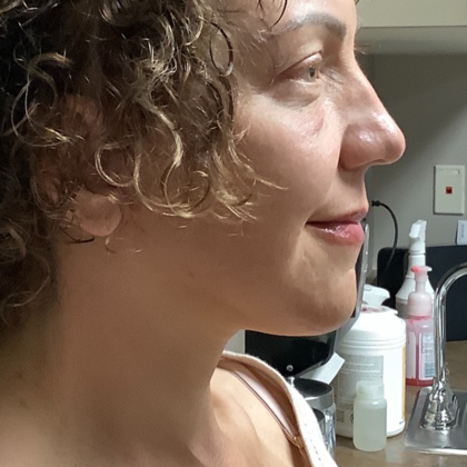 HourLift Before & After Patient #10879