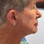HourLift Before & After Patient #10891