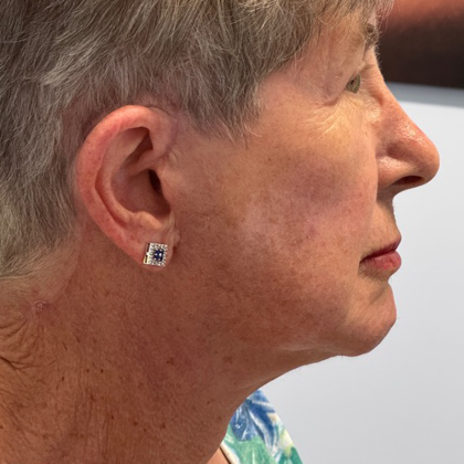 HourLift Before & After Patient #10891