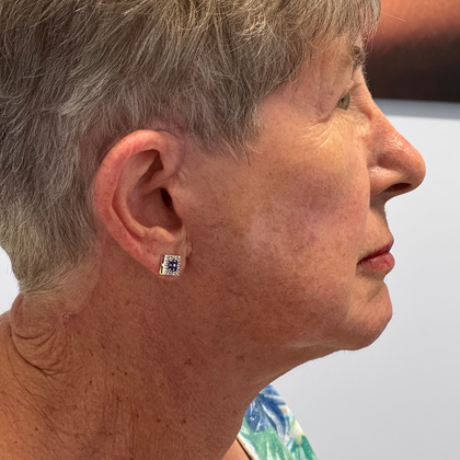 HourLift Before & After Patient #10860