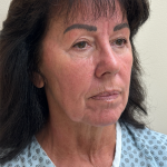 HourLift Before & After Patient #10990