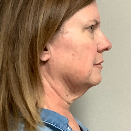 HourLift Before & After Patient #10992
