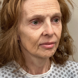 HourLift Before & After Patient #10975