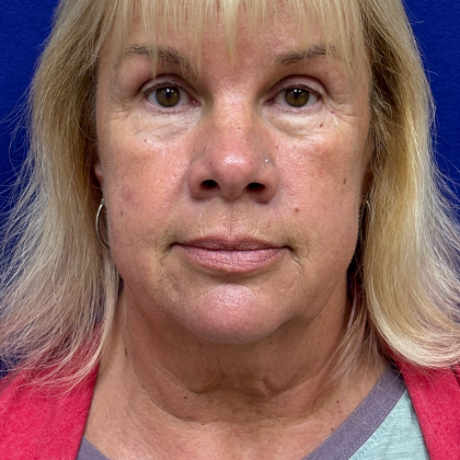 HourLift Before & After Patient #11003