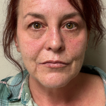 HourLift Before & After Patient #11009