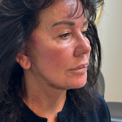 HourLift Before & After Patient #10990