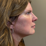 HourLift Before & After Patient #10992