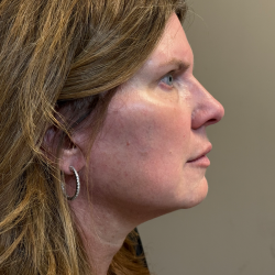 HourLift Before & After Patient #10992