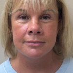 HourLift Before & After Patient #11003