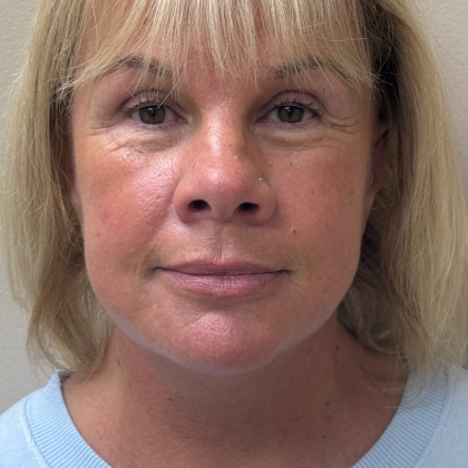 HourLift Before & After Patient #11003