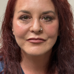 HourLift Before & After Patient #11009