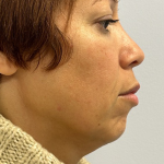 HourLift Before & After Patient #10989