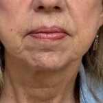 HourLift Before & After Patient #10988