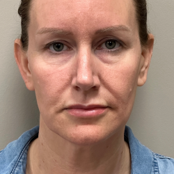 HourLift Before & After Patient #10991
