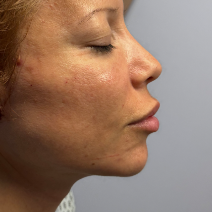 HourLift Before & After Patient #10989