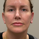 HourLift Before & After Patient #10991