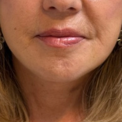 HourLift Before & After Patient #10988