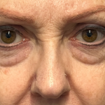 Blepharoplasty Before & After Patient #11019