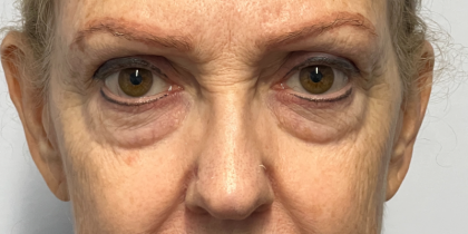 Blepharoplasty Before & After Patient #11019