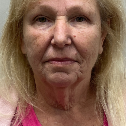 HourLift Before & After Patient #11022