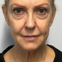 HourLift Before & After Patient #11016