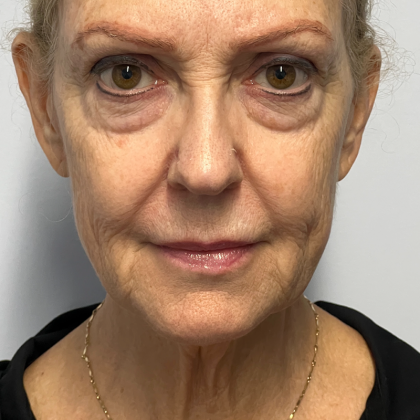 HourLift Before & After Patient #11016