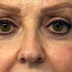 Blepharoplasty Before & After Patient #11019