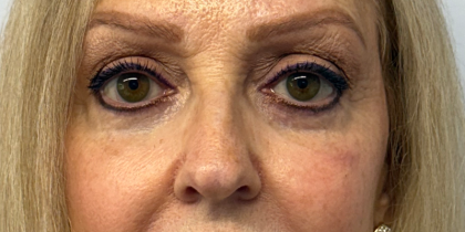Blepharoplasty Before & After Patient #11019