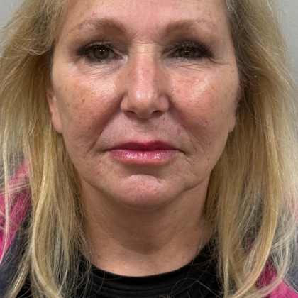 HourLift Before & After Patient #11022