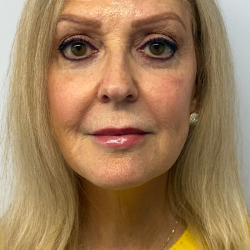 HourLift Before & After Patient #11016