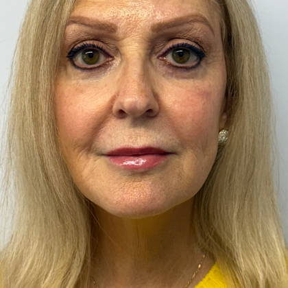 HourLift Before & After Patient #11016