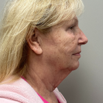 HourLift Before & After Patient #11022