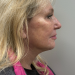 HourLift Before & After Patient #11022