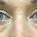 Blepharoplasty Before & After Patient #11036