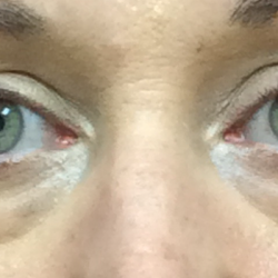 Blepharoplasty Before & After Patient #11036