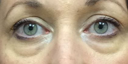 Blepharoplasty Before & After Patient #11036